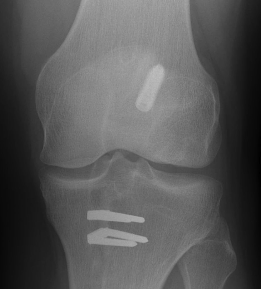 ACL Graft Rupture Graft Too Vertical